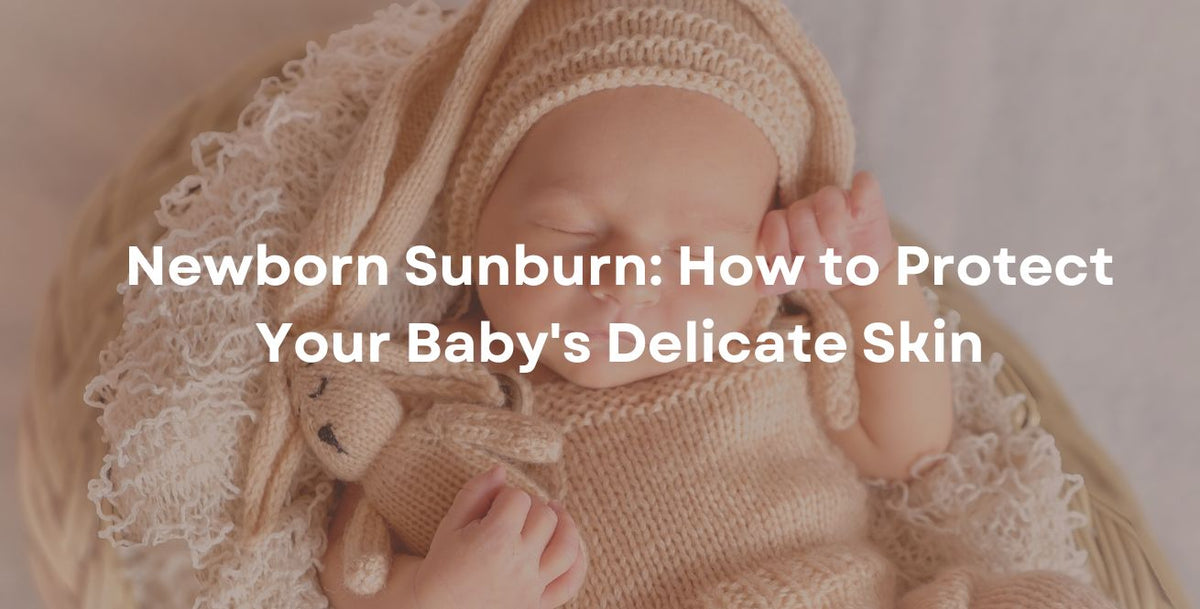 Newborn Sunburn: How to Protect Your Baby's Delicate Skin
