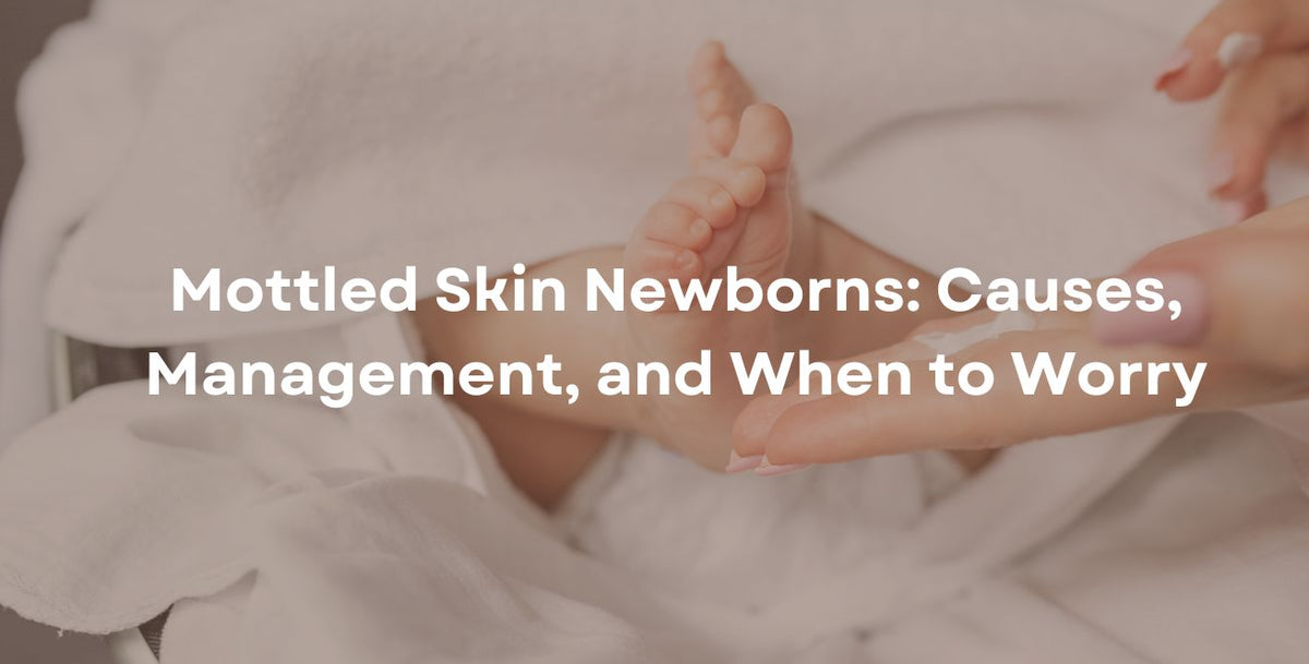 Mottled Skin Newborns: Causes, Management, and When to Worry